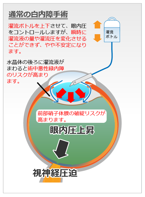 正常眼内圧白内障手術 岡本眼科 富山で日帰り白内障手術