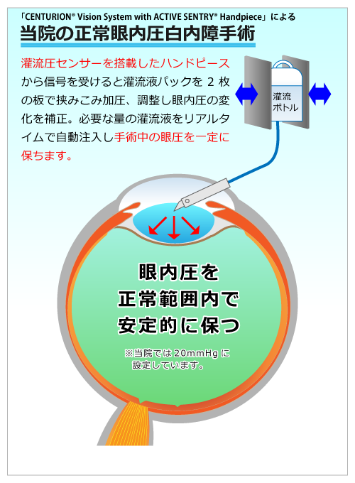 正常眼内圧白内障手術 岡本眼科 富山で日帰り白内障手術