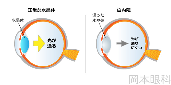 白内障とは？日帰り白内障手術 富山市天正寺 岡本眼科