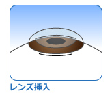 レンズ挿入・固定 フェイキックIOL 眼内レンズ 近視・遠視・乱視矯正 富山市天正寺 岡本眼科