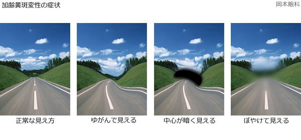 医師が説明する加齢黄斑変性 加齢黄斑変性の症状 加齢黄斑変性の治療 富山市天正寺 岡本眼科