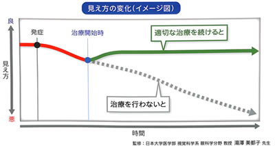 加齢黄斑変性の見え方の変化 富山市天正寺 岡本眼科 医師が説明する加齢黄斑変性 