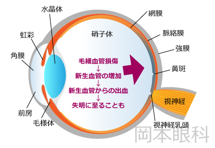 糖尿病網膜症とは？