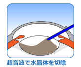 超音波白内障乳化吸引 日帰り白内障手術 富山市天正寺 岡本眼科