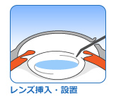 レンズ挿入 日帰り白内障手術 富山市天正寺 岡本眼科